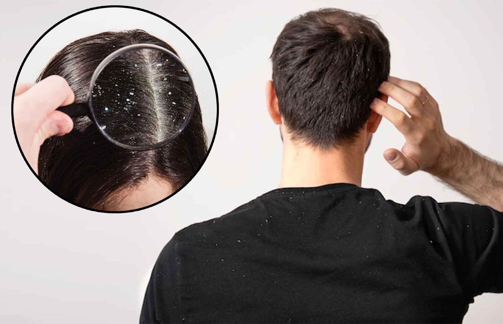 Dandruff Symptoms Causes Types Diagnosis And How To Get Rid